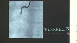 Perikardpunktion (Simulationstraining)