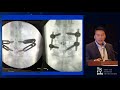 Expandable vs Static MIS TLIF Cages   Paul D  Kim, MD