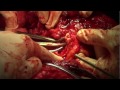 scapulectomy