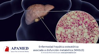 Esteatosis hepática asociada a disfunción metabólica (MASLD, NAFLD)