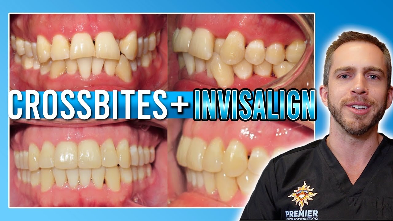 Crossbite Elastics Invisalign At Julie Neel Blog
