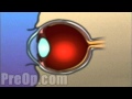 Laser Eye Surgery PRK PreOp® Patient Engagement and Education