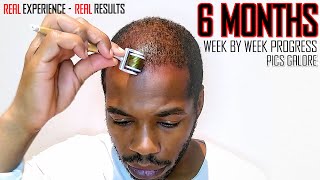 Derma roller Hair Regrowth Results 6 Months | Month by Month Progress | Coffee as a DHT Blocker