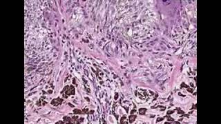 Histopathology Skin--Pigmented Spindle Cell Nevus