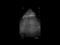 Skip Lesions / Patchy Infiltrate - Ultrasound Image Interpretation