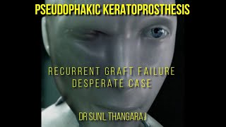 Keratoprosthesis for a recurrent graft failure using the AURO K PRO