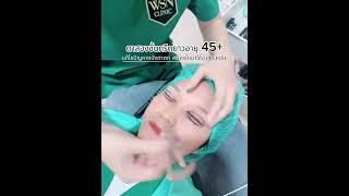 💢 รีวิวศัลยกรรม ตาสองชั้นกรีดยาว 45+ 💢แก้ไขปัญหาหนังตาตก สร้างชั้นตาให้สวยกลมโต 🥰