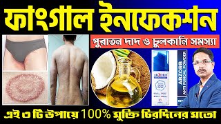 এই ৩ টি উপায়ে Fungal Infection / দাদ চুলকানি থেকে মুক্তি চিরদিনের মতো | ফাংগাল ইনফেকশনের চিকিৎসা |