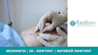 3D-МЕЗОНИТИ ДЛЯ КОРРЕКЦИИ ВОЗРАСТНЫХ ИЗМЕНЕНИЙ КОЖИ || ПОДТЯЖКА ЛИЦА БЕЗ ОПЕРАЦИЙ || МЕЗОНИТИ КИЕВ