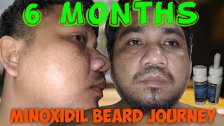 Minoxidil beard journey week 1-24 | how to grow a beard, 6 months progress minoxidil kirkland 5%