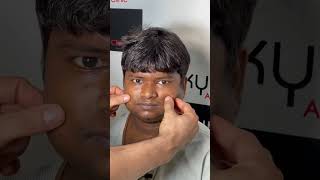 Buccal Fat Removal in Ludhiana Punjab at Kyra Clinic.