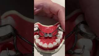 TUTORIAL - How to complete an incomplete Expander Turn