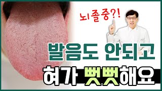 뇌졸중 루게릭 아닌데 혀가 뻣뻣해져서 발음이 잘 안 돼요