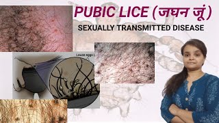 PUBIC LICE ll cause, symptoms, prevention, treatment ll