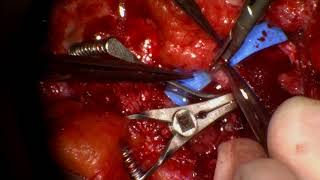 Microvascular Anastomosis - Breast Reconstruction video - Dr. Karen Horton - San Franciso, CA