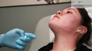 Kybella Injections for Chin and Neck Fullness