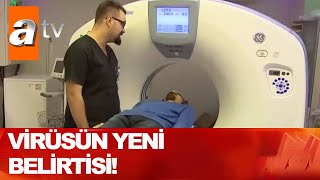 Koronavirüsün yeni belirtisi! - Gün Ortası