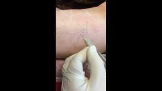 Spider Vein Removal By Dr Hanna | la Nouvelle Medical Spa, Oxnard, Ventura