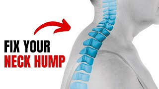 Fix Your Neck Hump At Home With FULL ROUTINE