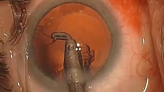 Polar cataract with posterior capsule true defect \u0026 CCC retrieval