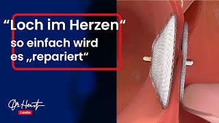 Schlaganfälle verhindern mit dem PFO-Verschluss | Dr. Heart