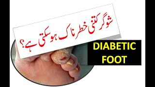 Diabetic Foot and Amputation of a Toe