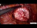 laparoscopic sacrocolpopexy for vaginal vault prolapse