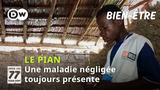 Le pian, une maladie négligée présente en RCA