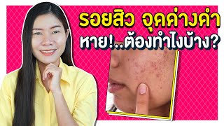 วิธีรักษารอยสิว รอยดำ รอยแดงจากสิว จุดด่างดำ มีอะไรบ้าง? Get Rid of Acne Scars| แนน Sister Nan