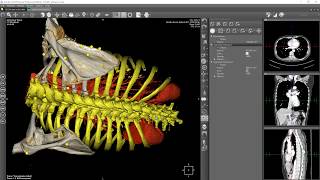 Marked watershed segmentation: bones and contrasted tissue separation