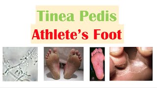 Athlete’s Foot (Tinea Pedis)| Causes, Risk Factors, Signs & Symptoms, Diagnosis