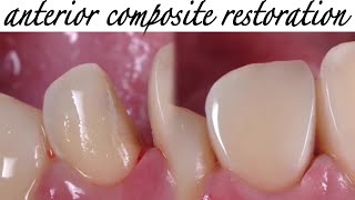 Anterior composite _ restoring peg shaped lateral incisor _ free hand technique