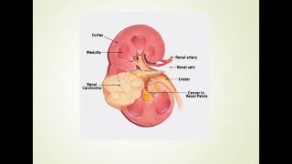 Tumors of Urinary System | Management | Urology Lecture | Ample Medical Lectures