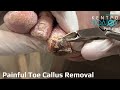 Toe Callus Removal|Αφαίρεση επίπονου επιδακτύλιου κάλου|Κέντρο Ποδιού Podiatry|Ποδιατρική|Ποδολογία