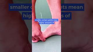 How high arch feet cause bruising