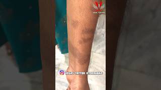 Kitchen లో కొంచెం జాగ్రత్త | #scarcoveruptattoo #burnscar #scartattoo #coveruptattoo #women #vegas