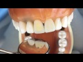 Porcelain Veneer Preparations with audio explanation