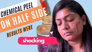 Surprising \u0026 shocking ways to use Chemical peeling solution at home