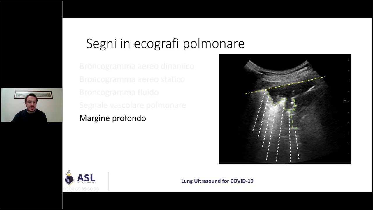 Ecografia Polmonare Per Le USCA 8 - Consolidamenti E Segni 3 - YouTube