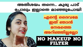 😱എന്റെ ദൈവമേ ഇത് ഞാൻ നേരത്തെ അറിഞ്ഞില്ലല്ലോ... 💯 ഇനി മുഖക്കുരു പാട് പോലുമില്ലാതെ മാഞ്ഞുപോകും....