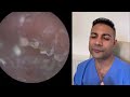 1 507 fully blocked infected dead skin removal due to otitis externa