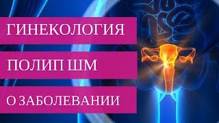 ПОЛИП ШЕЙКИ МАТКИ - о заболевании