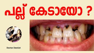 പല്ല് കേട്  | Tooth Decay explained | Doctor Dentist |