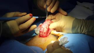 5S Penile Enlargement Surgery at Proud Urology Clinic