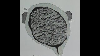 Hysteroscopy for Large Submucus Myoma