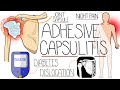 Adhesive Capsulitis (Frozen Shoulder Explained)