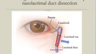 鼻淚管切開手術