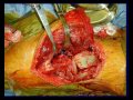 acetabulum fracture surgical approaches extended liofemoral ota lecture series iii v05c