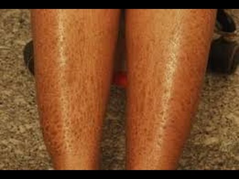 How to Heal Dry Skin on Legs How to Heal Dry Skin on Legs