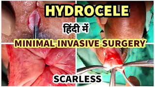 HYDROCELE - CHOOSE NO SCAR SURGERY -  FOR BEST RESULTS (MINIMAL INVASIVE TECHNIQUE)